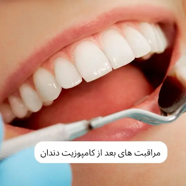 مراقبت های بعد از کامپوزیت دندان